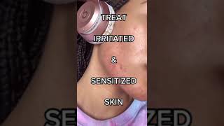 HOW TO TREAT IRRITATED AND SENSITIZED SKIN fast and easy‼️😅 [upl. by Bushore]