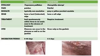 DIFFERENCES BETWEEN CHANCRE AND CHANCROID [upl. by Assirrak807]