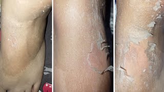 Body Chemical Peel At Home [upl. by Melentha157]