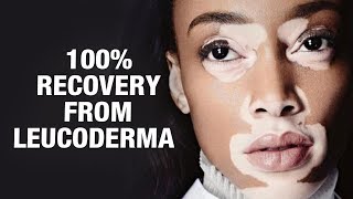 100 Recovery from Leucoderma   Dr Nitika Kohli  AIMIL Healthcare [upl. by Leah]