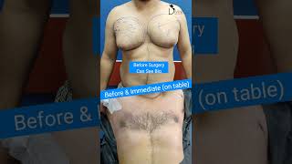 Gynecomastia Gland Removal Surgery  Before amp Immediate Results of Gynecomastia Surgery [upl. by Dahlia]