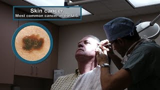 Mayo Clinic Minute 3 Types of skin cancer [upl. by Atalanta]