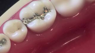 class II amalgam cavity preparation and restoration [upl. by Honeyman]