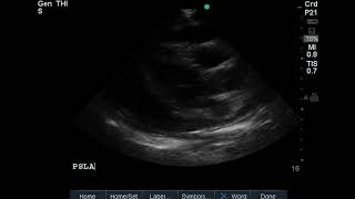 PSLA electrical alternans [upl. by Weinman]