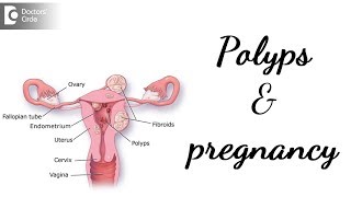 Do polyps stop you getting pregnant amp its management  Dr Rashmi Yogish [upl. by Nosaes]