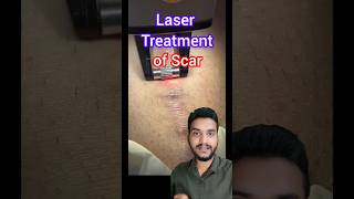 Laser treatment Keloid scar shorts [upl. by Alvar]