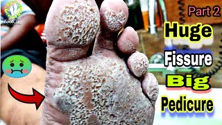 Pedicure huge Fissure on the tutorial  🔥  Footcare33 [upl. by Albemarle615]