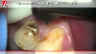 CARIES REMOVAL Fotona Lightwalker ErYAG laser [upl. by Aneev]