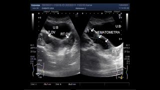 Hematometra in 25 years old unmarried lady [upl. by Nosloc479]