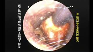 Regular followup and cleaning of external auditory canal cholesteatoma [upl. by Chil]