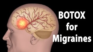 BOTOX for Migraines Animation [upl. by Ycnay265]