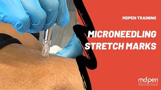 STRETCH MARKS MICRONEEDLING PROCEDURE  MDPEN TRAINING [upl. by Yde]