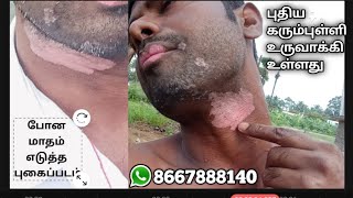 வெண்புள்ளி விரைவில் மறைய இயற்கை வைத்தியம்  vitiligo makeup cream [upl. by Anihpesoj]