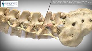 01 Endoscopic Facet Rhizotomy [upl. by Harbert]