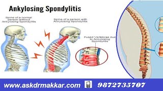 Hlab27 Ankylosing Spondolysis Permanent TreatmentAnkylosis Homeopathic  Explanations how to cure [upl. by Elyac746]