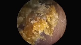 Satisfying Ear Wax Removal With Dokter Tht [upl. by Imiaj45]