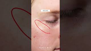 Before and After IPL Laser LUMECCA Kami Parsa MD  PARSA MD skincare [upl. by Strade]