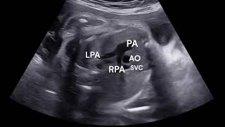 FETAL ECHO  NORMAL BASIC AND EXTENDED VIEWS IN GREYSCALE [upl. by Decamp]