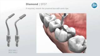 Preparation rules for ceramic inlays and partial crowns [upl. by Blackmore]