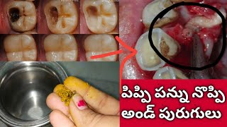 instant teeth pain relief పిప్పి పన్ను నొప్పి ఒక్క రోజులో తగ్గిపోయి పురుగు బయటకి వచ్చేస్తుంది [upl. by Welford428]