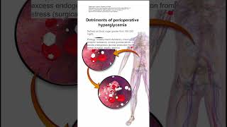 Detriments of perioperative hyperglycemia [upl. by Aynat]