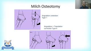 Complications of Lateral condyle Fractures and their Management by Dr Kapil Gangwal [upl. by Sarina437]