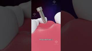 Bone Grafting for Dental Implants shorts facts  creativelearning3d [upl. by Adnauq]