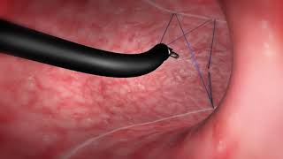 OverStitch Endoscopic Sleeve Gastroplasty [upl. by Eugen420]