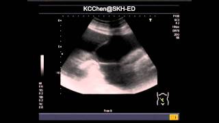 Sclerosing Encapsulating Peritonitis [upl. by Farrow55]