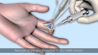 CapFlex PIP – Endoprosthetic treatment of the proximal interphalangeal joint palmar approach [upl. by Koffler]