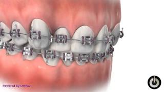 Spacers Before Braces [upl. by Urbani]