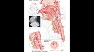 Plummer Vinson Syndrome [upl. by Eiclek]