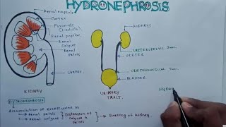 HYDRONEPHROSIS  Pathophysiology Causes signs and symptoms background diagnosis and treatment [upl. by Anilatsyrc]