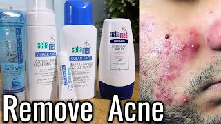 Best Medicated Acne Face Wash Acne amp Pimples Removal Products Urdu Hindi [upl. by Acimot]