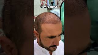 🤩14days hair transplant update Notice the grafts starting to settle💯 and new growth emerging👍 [upl. by Duleba]