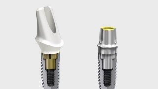 Nobel Biocare Implant Systems [upl. by Willtrude132]