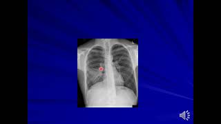 Suppurative lung diseases [upl. by Nayab]