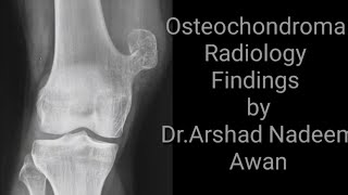 Osteochondroma Radiology x rays and CT images [upl. by Bonnell197]