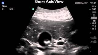 How To Gallbladder Ultrasound Part 2  Gallstones Case Study Video [upl. by Dnalro]