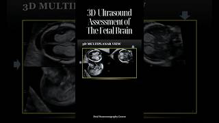 3D Ultrasound Assessment of The Fetal Brain [upl. by Warder408]