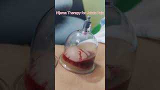 Hijama Cupping Therapy for Joint Pain amp Skin Diseases hijama cupping jointpain skindiseases [upl. by Einittirb909]