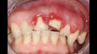 Injuries to permanent dentition [upl. by Ellerud]