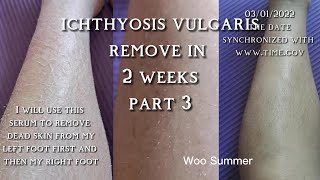 How to get rid of ichthyosis vulgaris dry skinremoved in 2weeks part 3 [upl. by Feer]