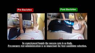 Intrathecal Baclofen Pump Surgery is so effective on Spasticity treatment [upl. by Airotnahs]