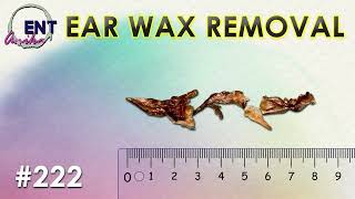 Ear Damage Epidemic Is Earwax or Earbuds to Blame [upl. by Attah]