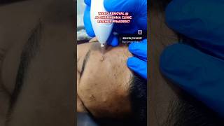 Warts Removal By Laser Treatment warts laser pimple beauty skincare shorts rcr [upl. by Ahseyi]