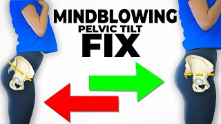 The Mindblowing Best Fix For Anterior Pelvic Tilt instant results [upl. by Alroy513]