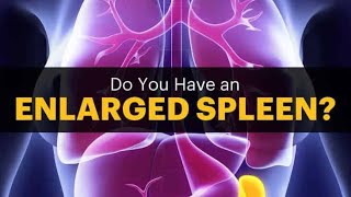 Splenomegaly Enlarged Spleen Splenitits Treatment and Cure [upl. by Weight741]