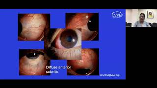 Lecture Infectious Scleritis Difficulties in Diagnosis and Management [upl. by Yrennalf241]