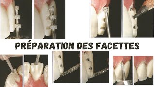 Facettes Dentaires  PRÉPARATION [upl. by Gauntlett586]